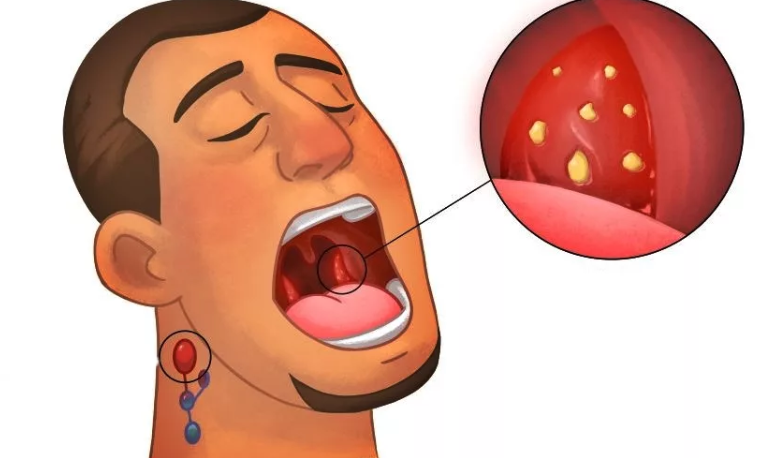 Лечение ангины