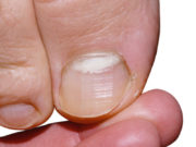 Современный метод лечения грибка ногтей