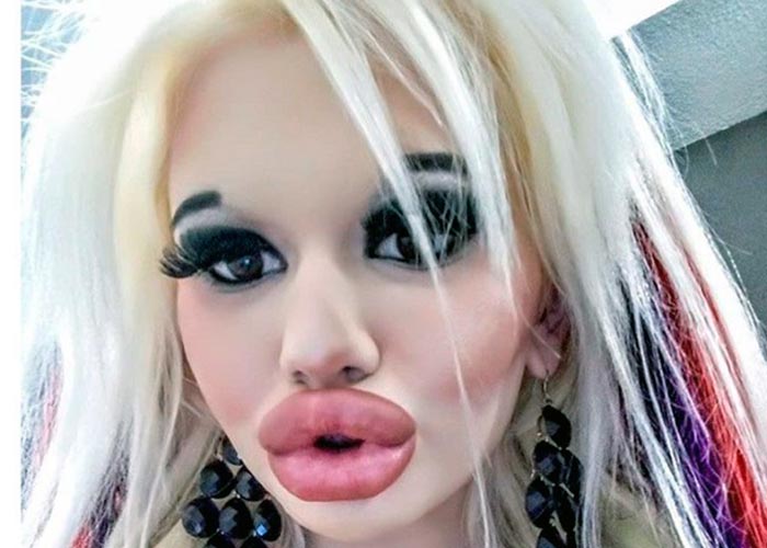 Девушка с самыми большими губами в мире показала результат 20-й пластической операции