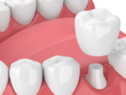 Преимущества циркониевых коронок