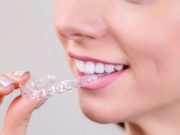 Элайнеры: инновационная система коррекции прикуса