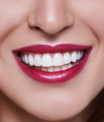 Профессиональная чистка зубов: как проходит процедура?