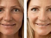 Химический пилинг: в чем его эффективность?