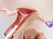 Искусственная инсеминация спермой мужа: понятие и основные индикации для процедуры